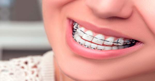 campeón Perforación principal Algunas razones por las que debes hacerte ortodoncia | Centauro