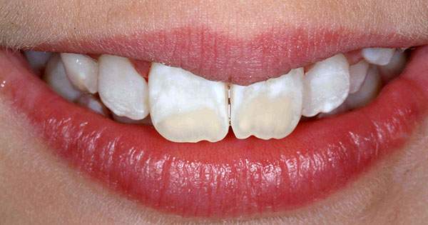 Causas de las manchas en los dientes