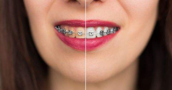 Contracción más Tía Diferencia entre blanqueamiento dental y limpieza dental | Centauro