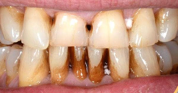 Inesperado en progreso asistencia La placa dental y el riesgo de cáncer | Centauro
