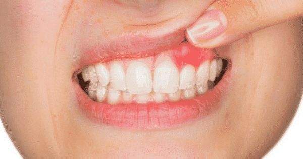Enfermedades dentales: ¿Qué es el flemón y cuánto tiempo dura?