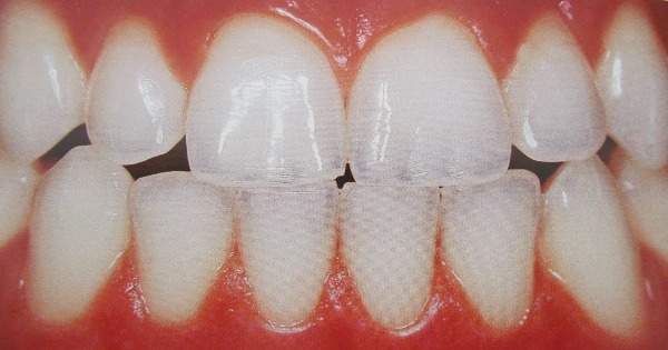 cómodo aceleración Pino Qué es y cómo se protege el esmalte dental? | Centauro